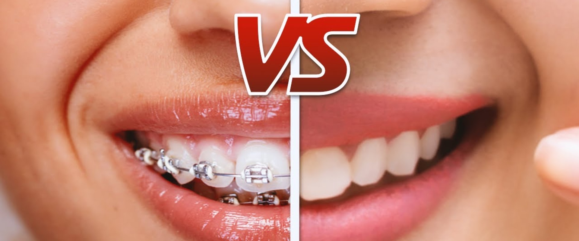 How Much Does Teeth Straightening Cost? A Comprehensive Guide