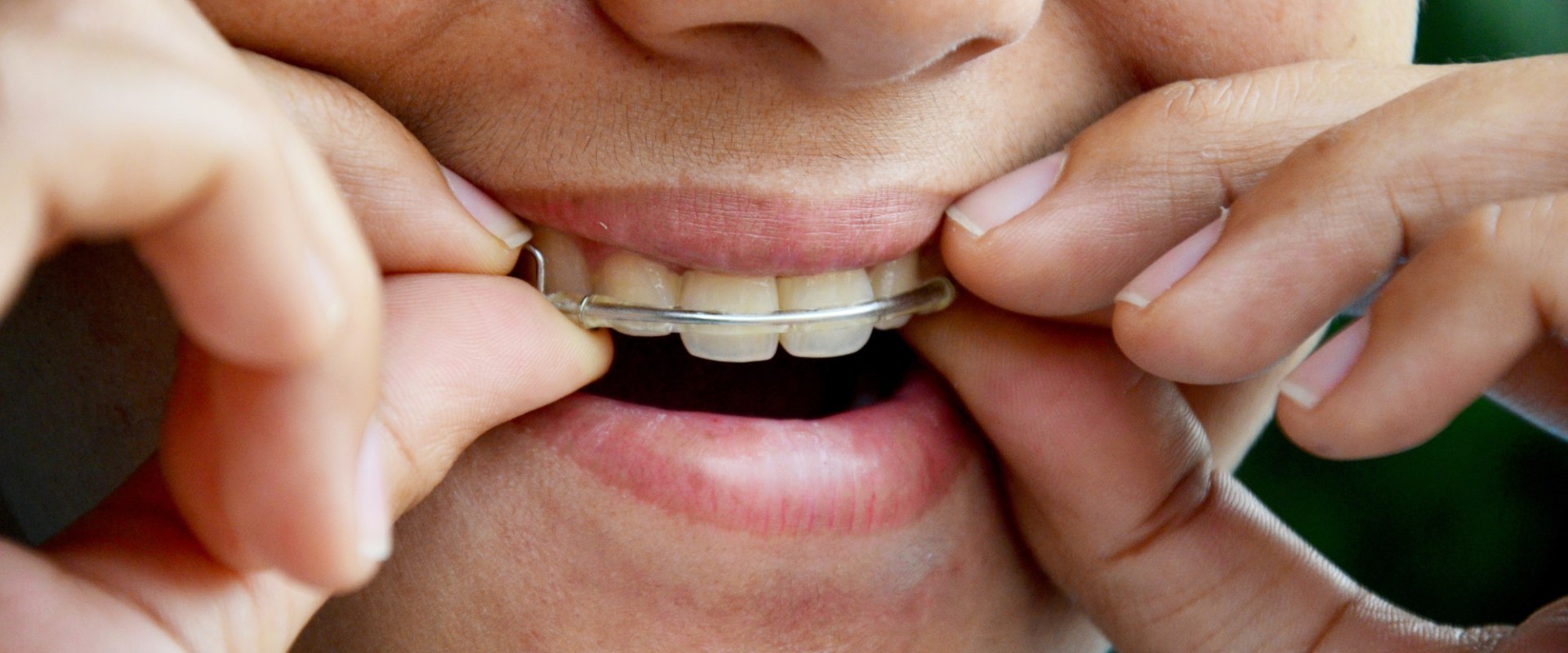 How Long Should You Wear Retainers After Teeth Straightening?