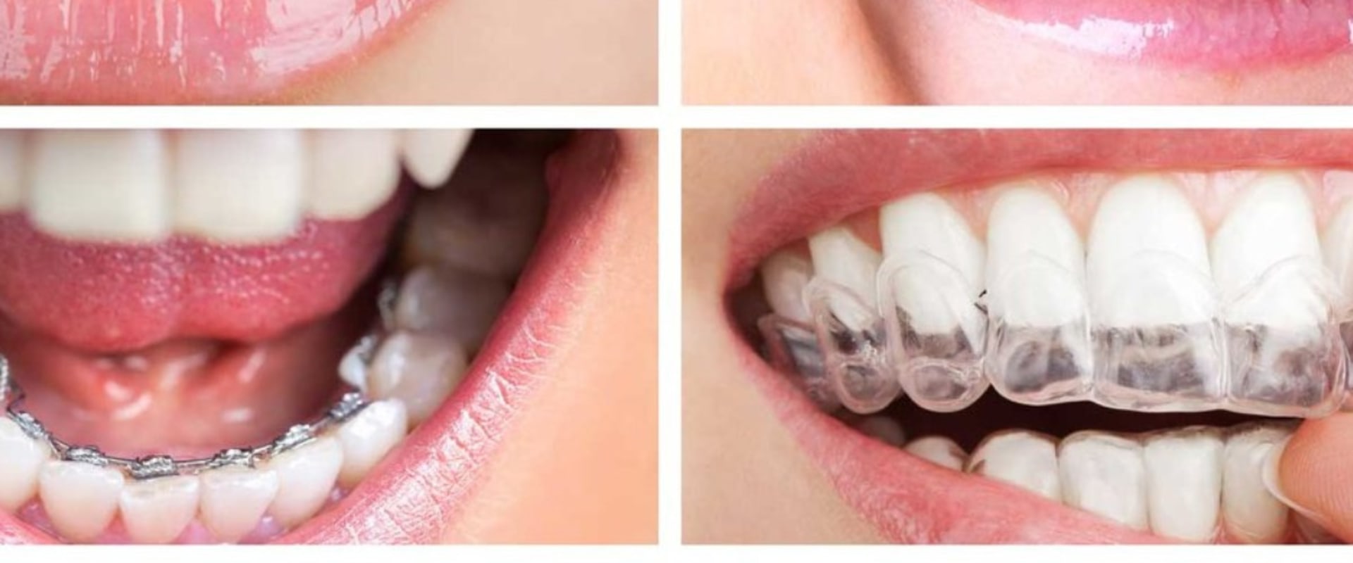 The Different Types of Teeth Straightening Explained