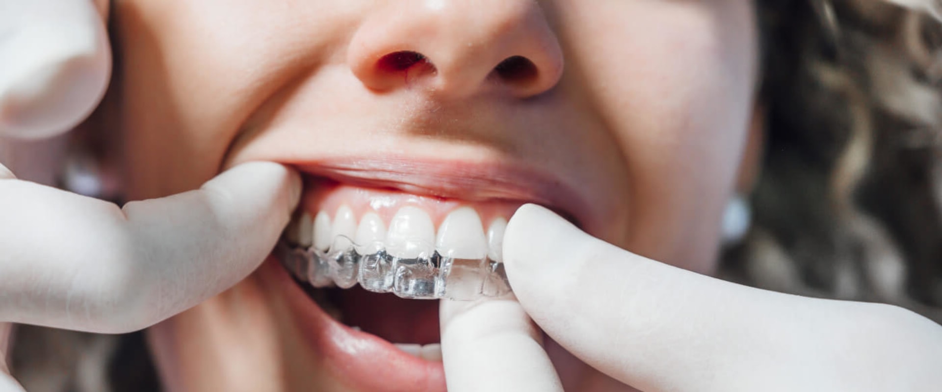 Strpping Tooth Everything You Need to Know About Teeth Straightening