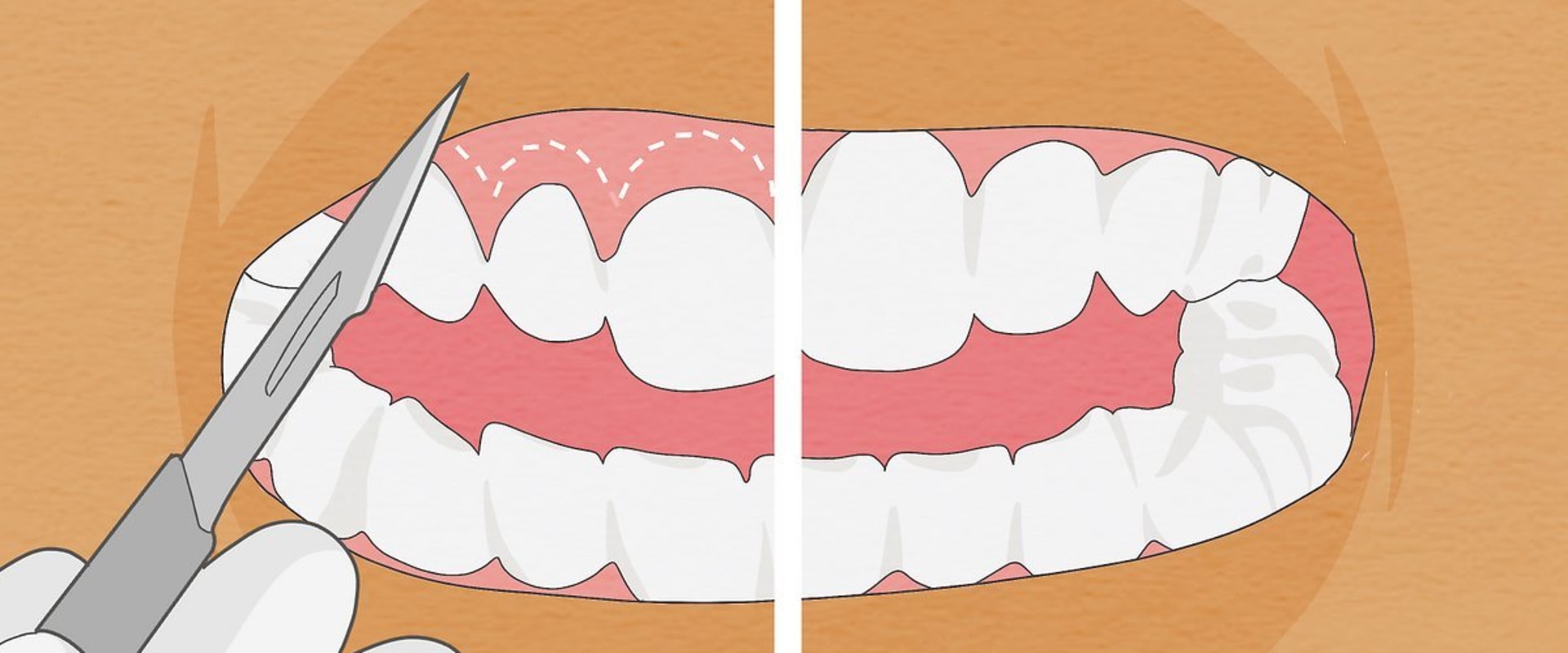 Straightening Teeth: The Best and Fastest Way to Achieve a Perfect Smile