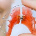 Do I Need to Wear a Retainer After Getting My Teeth Straightened?