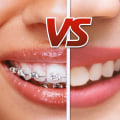 How Much Does Teeth Straightening Cost? A Comprehensive Guide
