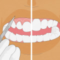 What Foods Can Help You Get Your Teeth Straightened?