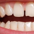 Can I Get My Teeth Straightened If I Have a Missing Tooth or Gap in My Smile?