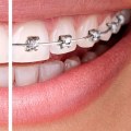 Straightening Teeth: Braces vs Clear Aligners