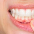 Can I Get My Teeth Straightened If I Have a Gum Disease or Infection?