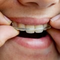 How Long Should You Wear Retainers After Teeth Straightening?