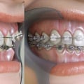 Straightening Teeth: Braces vs Invisalign