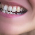 What are the Side Effects of Teeth Straightening?