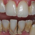Can I Get My Teeth Straightened If I Have a Crown or Veneer?