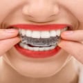 Can Invisalign Help Straighten My Child's Teeth?