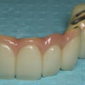 Can I Get My Teeth Straightened with a Dental Implant or Bridge?