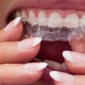 Invisalign vs Braces: Which is Better for Children's Teeth Alignment Needs?