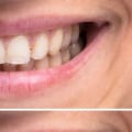 Can I Whiten My Teeth While Getting My Teeth Straightened?