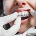 Everything You Need to Know About Teeth Straightening