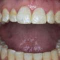 Do I Need Special Toothpaste for Teeth Straightening?