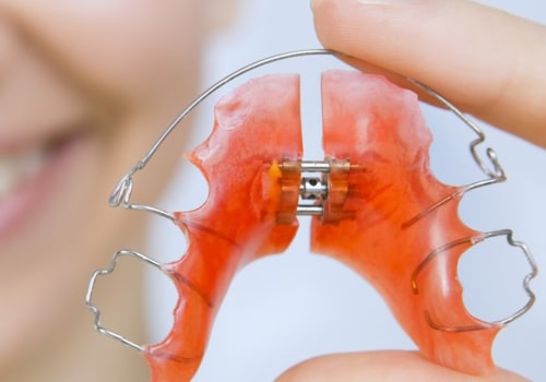 Do I Need to Wear a Retainer After Getting My Teeth Straightened?