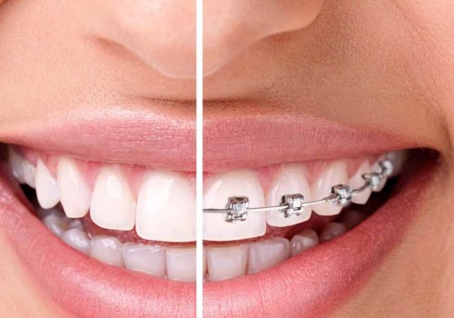 What Happens After Teeth Straightening? A Comprehensive Guide