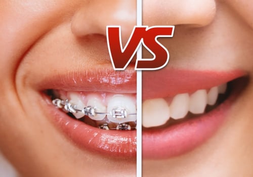 How Much Does Teeth Straightening Cost? A Comprehensive Guide