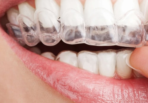 Are Invisalign Aligners Safe for Children's Teeth Alignment Needs?