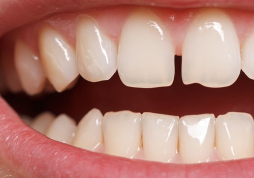 Can I Get My Teeth Straightened If I Have a Missing Tooth or Gap in My Smile?