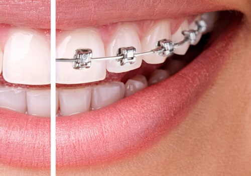 Straightening Teeth: Braces vs Clear Aligners