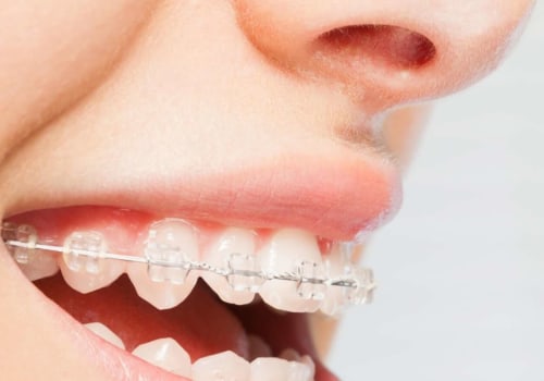 What Activities Should I Avoid When Getting My Teeth Straightened?