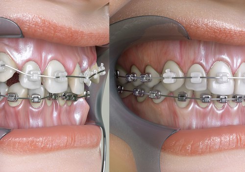 What Type of Braces Should I Use for Teeth Straightening?