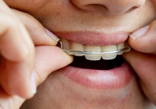 How Long Should You Wear Retainers After Teeth Straightening?