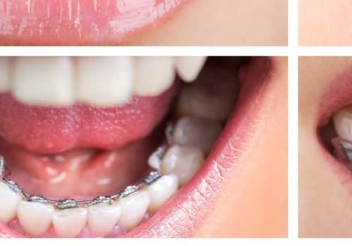 The Different Types of Teeth Straightening Explained