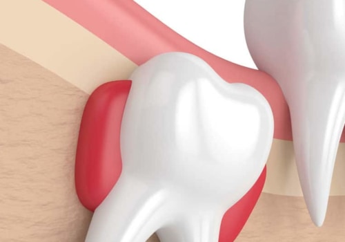 Can I Get My Wisdom Teeth Removed While Straightening My Other Teeth?