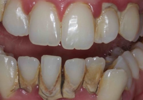 Can I Get My Teeth Straightened If I Have a Crown or Veneer?