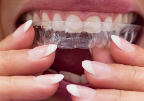 Invisalign vs Braces: Which is Better for Children's Teeth Alignment Needs?