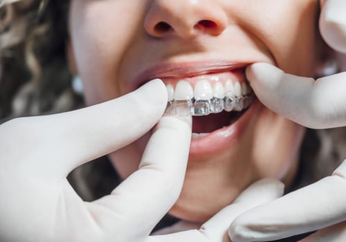 Everything You Need to Know About Teeth Straightening